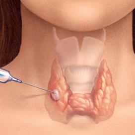 Пункционная биопсия щитовидной железы